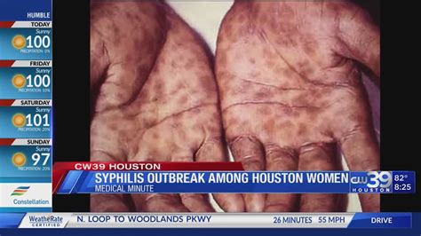 syphilis outbreak atlanta|Syphilis